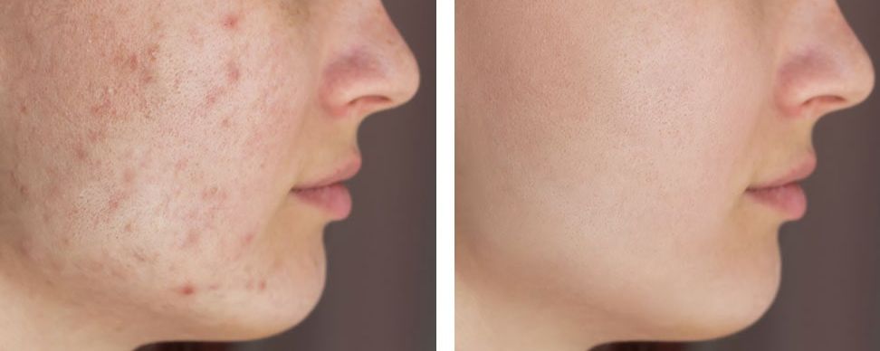 Before &After